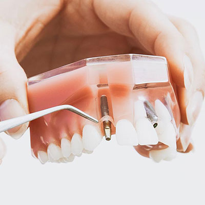 Implantología. Clínica dental Dr. Alcubierre