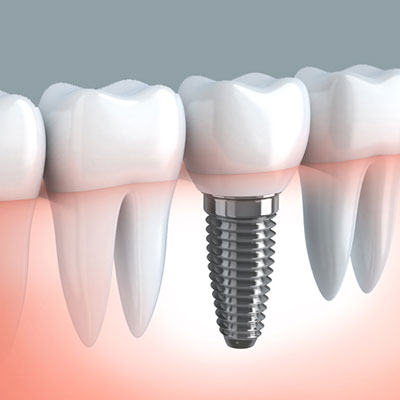 Implantología. Clínica dental Dr. Alcubierre